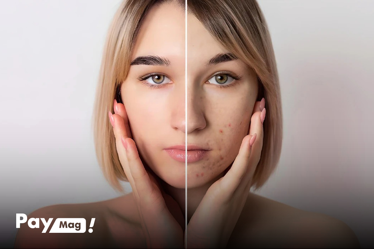 درمان جوش صورت با روغن درخت چای