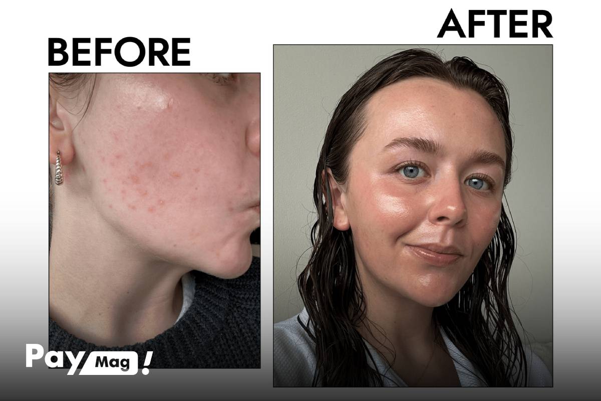 کرم ترتینوئین چیست