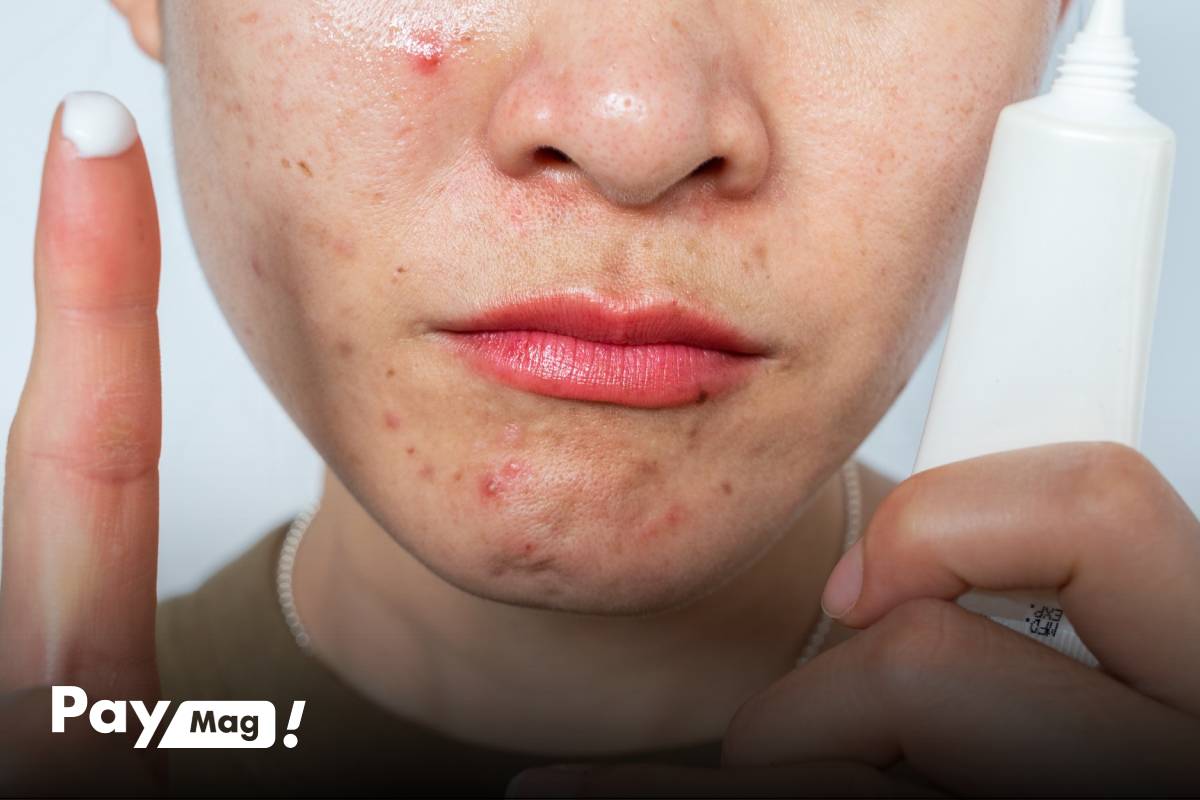 کرم ترتینوئین