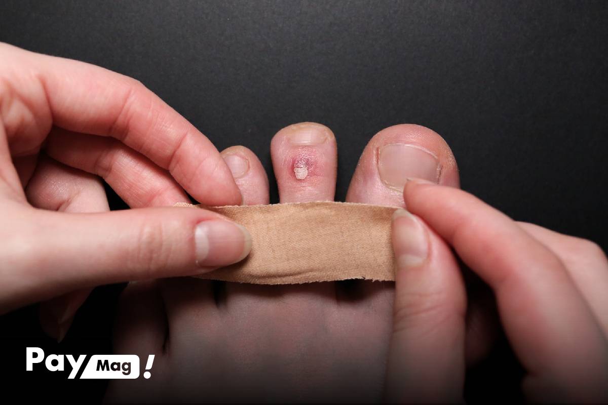 درمان فوری میخچه پا