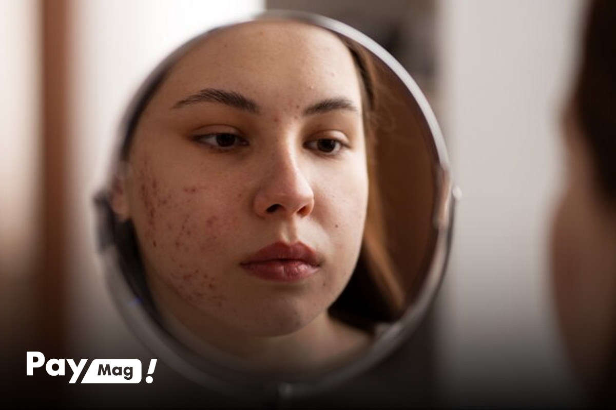 برای از بین بردن جوش صورت