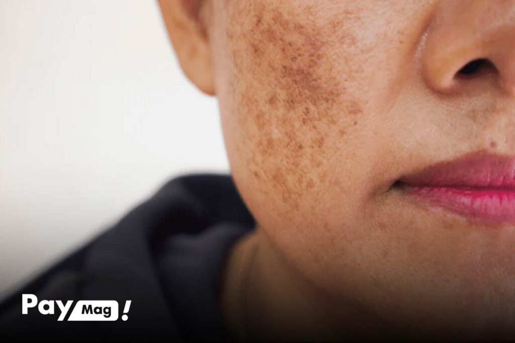 پماد هیدروکورتیزون برای لک صورت