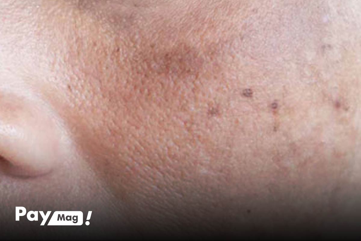 عکس پماد هیدروکورتیزون برای لک صورت