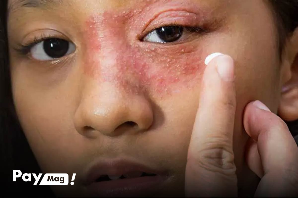 ایا پماد هیدروکورتیزون برای لک صورت خوبه