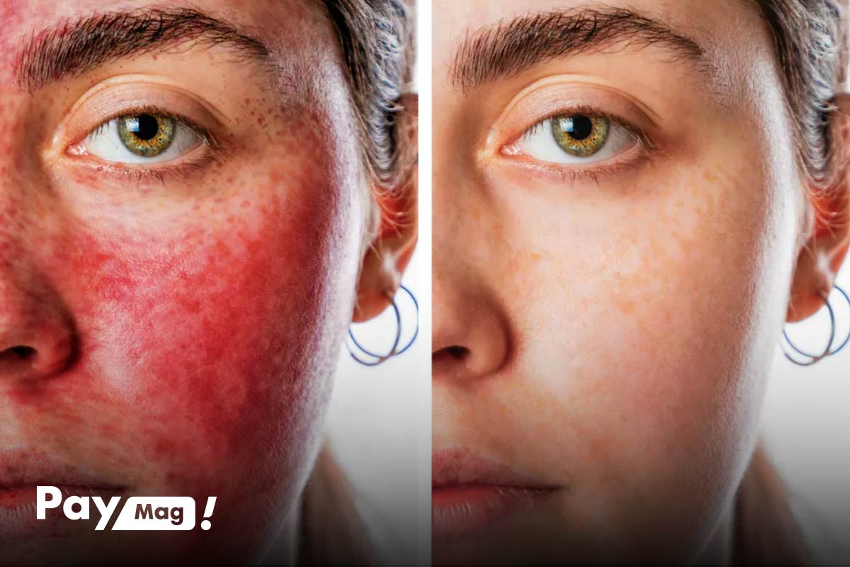 PRP FACIAL