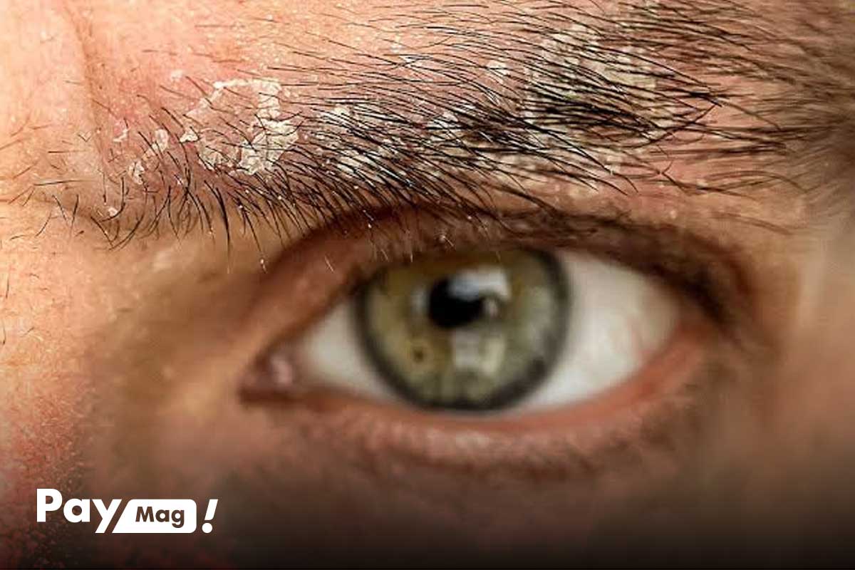 پوسته پوسته شدن پوست بعد از کاشت